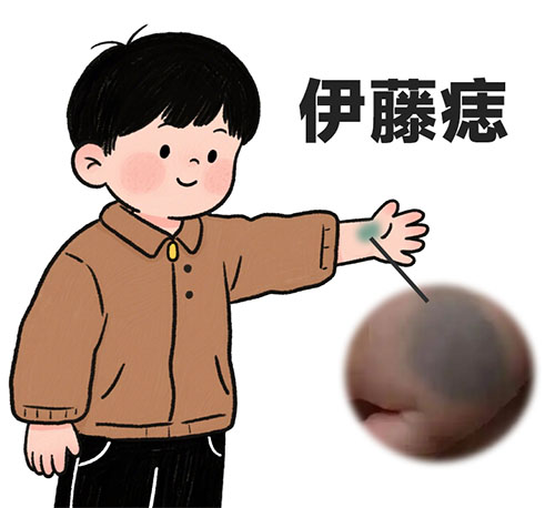 伊藤痣和蒙古斑怎么区分？别再分不清了