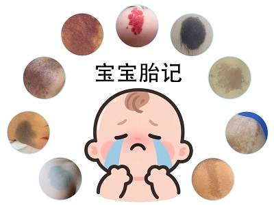 胎记有什么颜色？不同颜色的胎记代表什么？